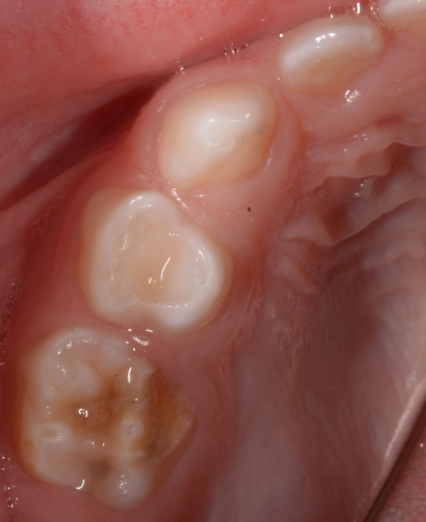 Poškodenie moláru v dočasnom chrupe (DMH)